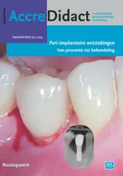 Omslag van Peri-implantaire ontstekingen
