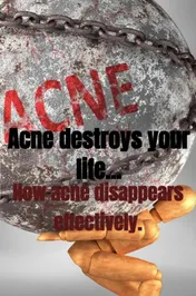 Omslag van Acne destroys your life...
