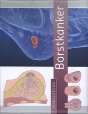 Omslag van Borstkanker