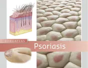 Omslag van Psoriasis
