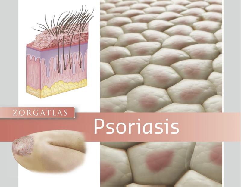 Omslag van Psoriasis