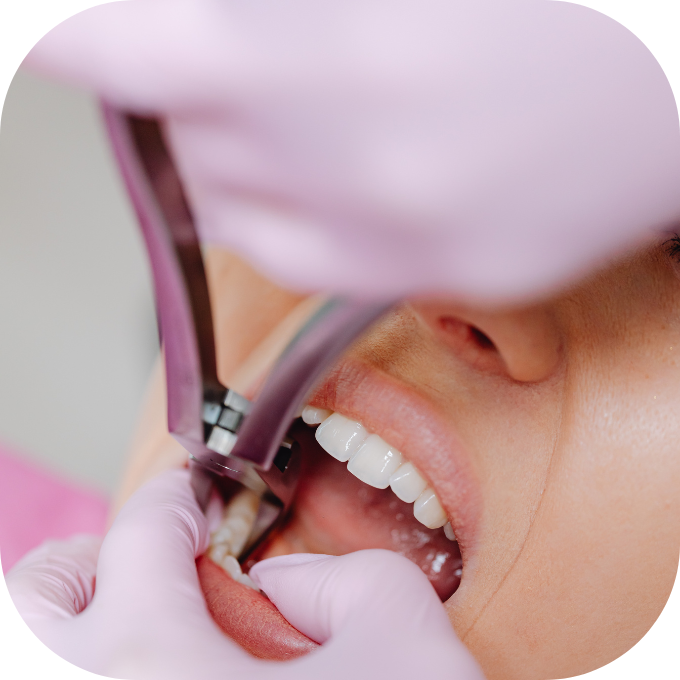 Phương pháp lấy cao răng Kingfoodmart