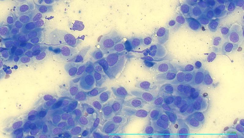 Carcinoma prostático con sonda1.jpg