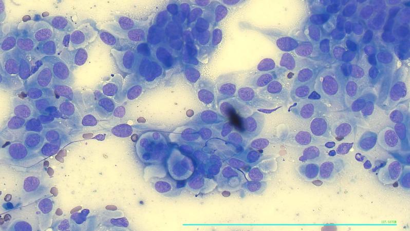 Carcinoma prostático con sonda2.jpg