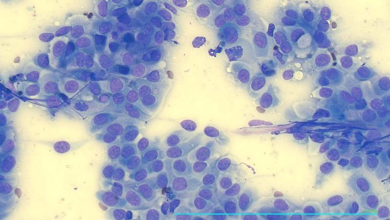 Carcinoma prostático con sonda3.jpg