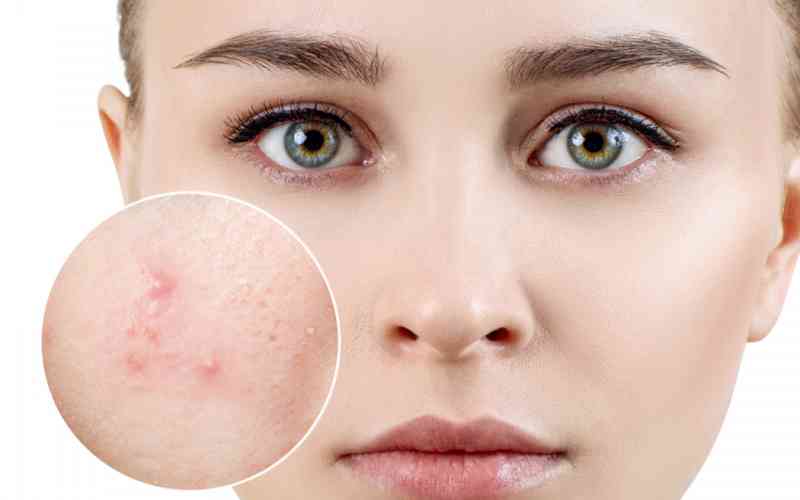 Cách kết hợp Klenzit MS và Derma Forte 