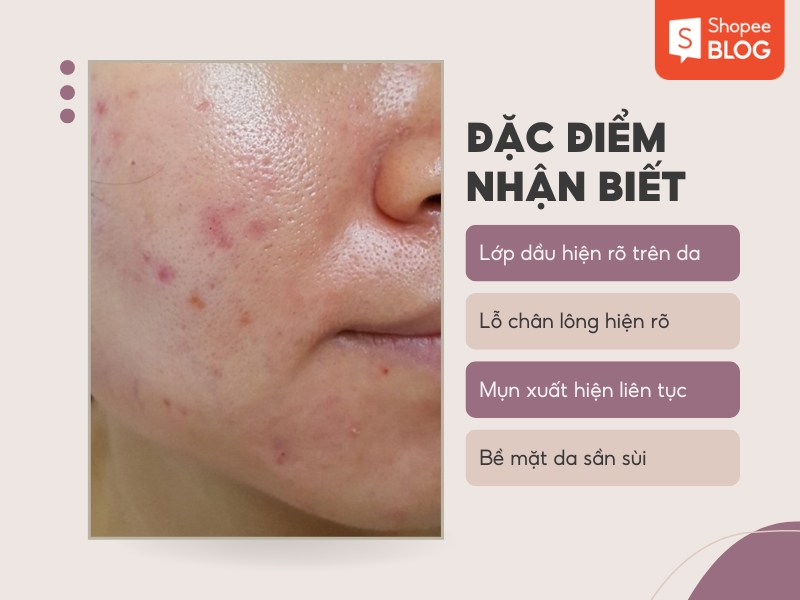 Đặc điểm da dầu mụn lỗ chân lông to