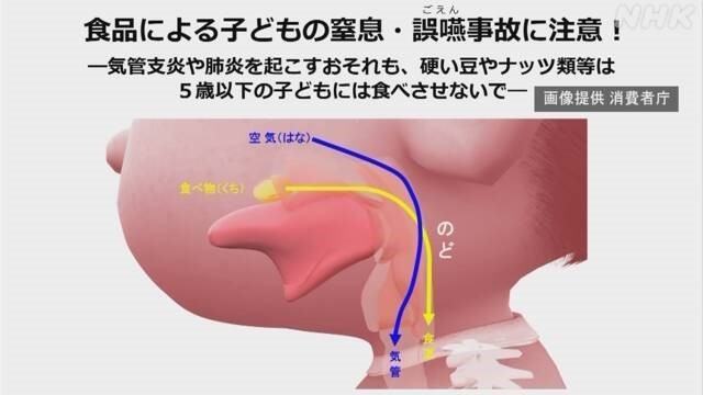 子どもの窒息・誤嚥（ごえん）事故