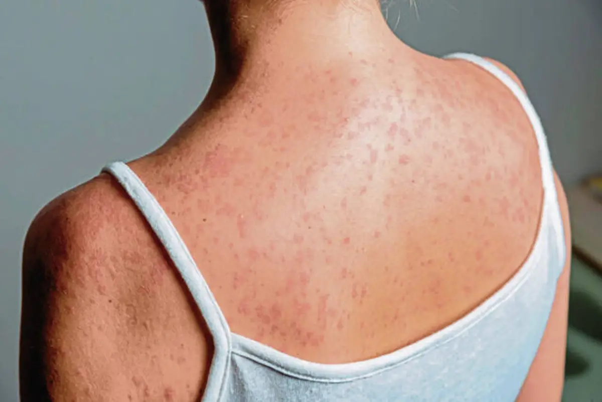 Washington County records 1st confirmed measles case