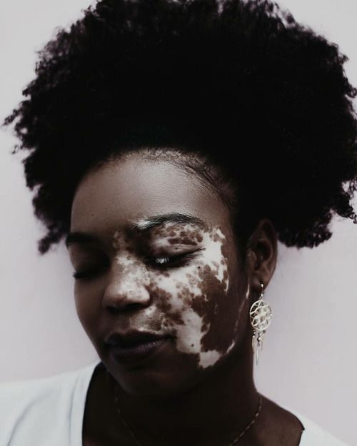 a closeup portrait of a woman with vitiligo, a skin condition causing loss of pigment in patches. she has dark skin and afro hair. her eyes are closed, and her face shows the distinct patterns of vitiligo. she wears an earring and a necklace. the photo focuses on her face, highlighting beauty and diversity in representation.