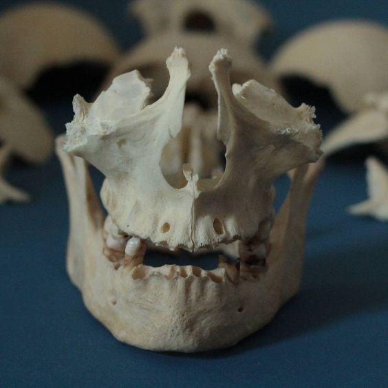 a closeup shot of the lower jawbone of a child's skull, surrounded by other bone fragments, against a blue background. the jawbone is positioned facing forward, showcasing the teeth and the intricate structure of the bone.