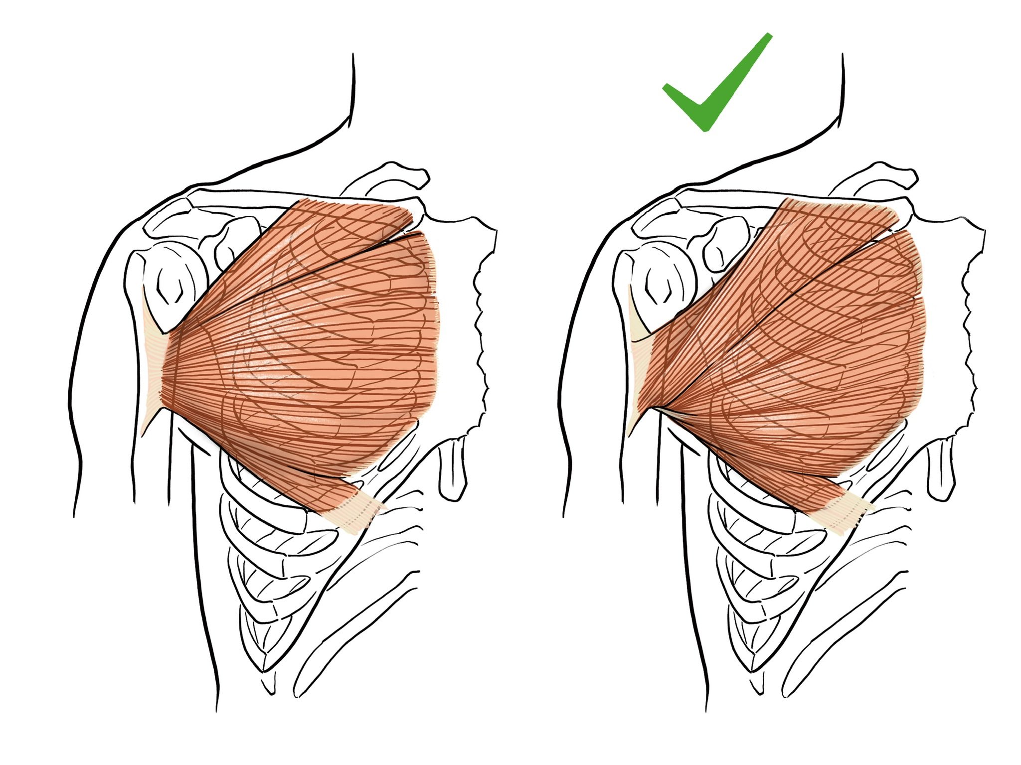 the image is a comparative illustration of the pectoralis minor muscle.  two depictions of the upper body's anterior torso are shown.  the left image shows the muscle with incorrect positioning or an example of poor posture, while the right image (marked with a green checkmark) illustrates the correct anatomical positioning of the pectoralis minor muscle. the illustration highlights the muscle's origin at the ribs and its insertion at the coracoid process of the scapula. the surrounding skeletal structures, including ribs and clavicle, are also shown in a simplified outline. the style is a clean line drawing with shading used to represent the muscle's fibers.