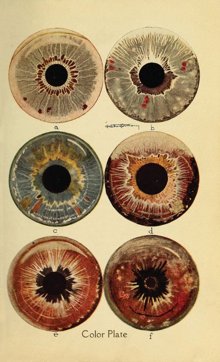 the image is a color plate showcasing six different human irises (af) labeled alphabetically. each iris displays unique patterns, textures, and color variations, likely intended for analysis or diagnosis within a medical context, possibly iridology.