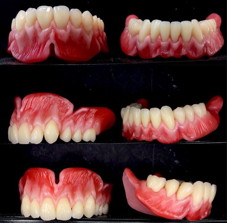 the image shows six different views of a set of upper and lower dentures in various stages of production.  they appear to be made of wax and are displayed on a black background, likely in a dental lab setting. the dentures are pink to simulate gum tissue and feature white teeth.  some views show the dentures open, while others show them closed.  the images highlight the craftsmanship and detail involved in creating prosthetic teeth.