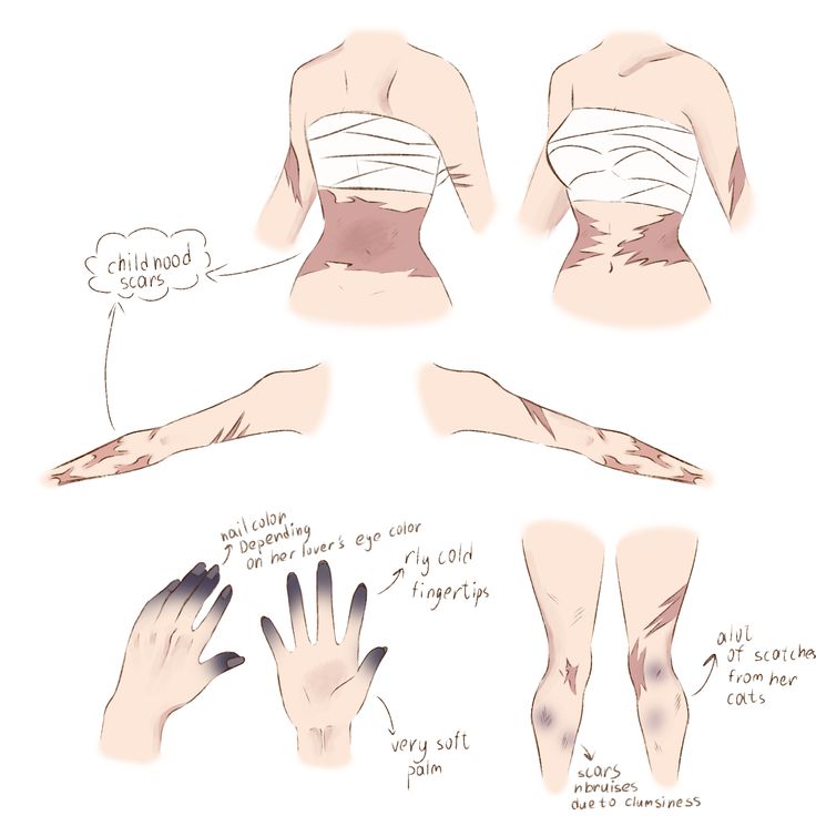 his image shows a collection of sketches depicting various types of scars and injuries on a female character's body. the sketches include detailed closeups of hands and arms showing scars, and wider shots illustrating the distribution of scarring on the torso and legs.  annotations on the image indicate the types of injuries (childhood scars, selfharm scars, cat scratches, bruises from clumsiness), the color of nails (depending on the character's lover's eye color), and the texture of the palms (very soft).  the style is a soft, pasteltoned pencil or digital drawing. the overall impression is a character design reference sheet focusing on the physical features resulting from various types of trauma and physical interactions.