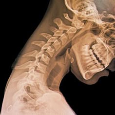 this is an xray image of the neck and spine of a human, showing the bones of the spine and neck. the xray reveals the structure of the bones and any potential abnormalities, making it valuable for diagnosis and treatment in healthcare.