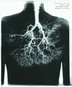 the image is an xray of the human chest, highlighting the lung airways.  it shows a network of branching airways, similar to a tree, extending from the trachea to the smaller bronchi.  the image is in black and white, with the airways appearing as white lines against a black background. it is a medical image used for diagnosing lung conditions.