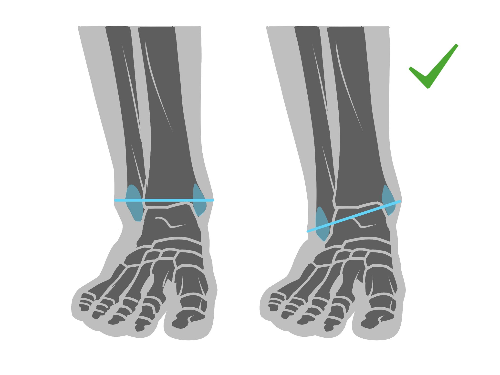 he image is a medical illustration comparing two views of an ankle.  the left ankle shows incorrect alignment, while the right ankle shows correct alignment.  a light blue line indicates the proper horizontal alignment of the medial and lateral malleoli (ankle bones). a green checkmark signifies the correct alignment on the right.  the illustration is a simplified skeletal representation of the lower leg and foot, highlighting the ankle joint.
