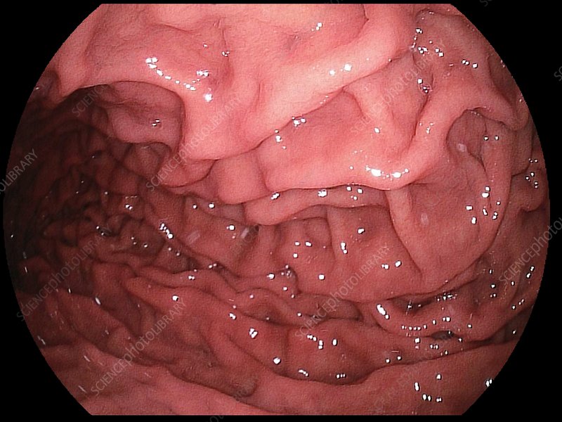 a closeup image of the small intestine taken during an endoscopy. the image shows the folds of the mucosa, which are the lining of the intestine. the folds are covered in villi, which are tiny fingerlike projections that increase the surface area of the intestine, allowing for more efficient absorption of nutrients. the image is a closeup of the small intestine. the image shows the healthy mucosa of the small intestine. the image shows the healthy folds of the small intestine. the image shows the healthy villi of the small intestine. the image shows the healthy lining of the small intestine. the image shows the healthy surface of the small intestine. the image shows the healthy structure of the small intestine. the image shows the healthy appearance of the small intestine. the image shows the healthy anatomy of the small intestine. the image shows the healthy physiology of the small intestine.