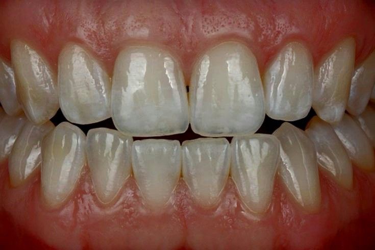 the image shows a closeup view of a person's teeth. the teeth are white and straight, and the gums are pink and healthy. the image is welllit, and the teeth are in focus. the image may have been taken after a teeth whitening treatment.
