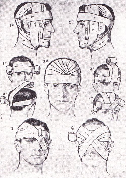 this is an anatomical illustration that shows how to bandage a person's head and face using a variety of methods. the image is a stepbystep guide for applying bandages to different areas of the head and face. there are numbered arrows and steps to follow, and each step is labeled with its own number. the illustration is useful for learning how to bandage head injuries and other injuries in the face. it would be useful for first aid training, medical professionals and lay people.
