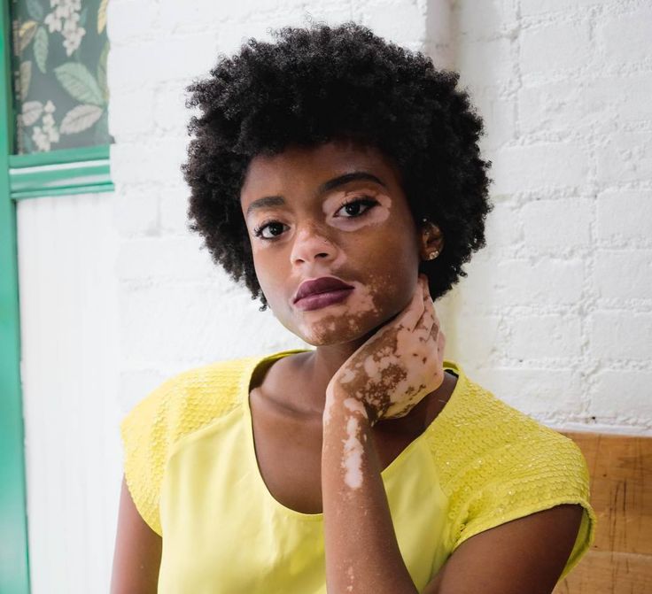 a portrait of a black woman with vitiligo, wearing a yellow shirt and maroon lipstick, with her hand resting on her neck. she has an afro and is standing in front of a white brick wall with green trim and a floral pattern on the left side. she is looking directly at the camera with a serious expression.
