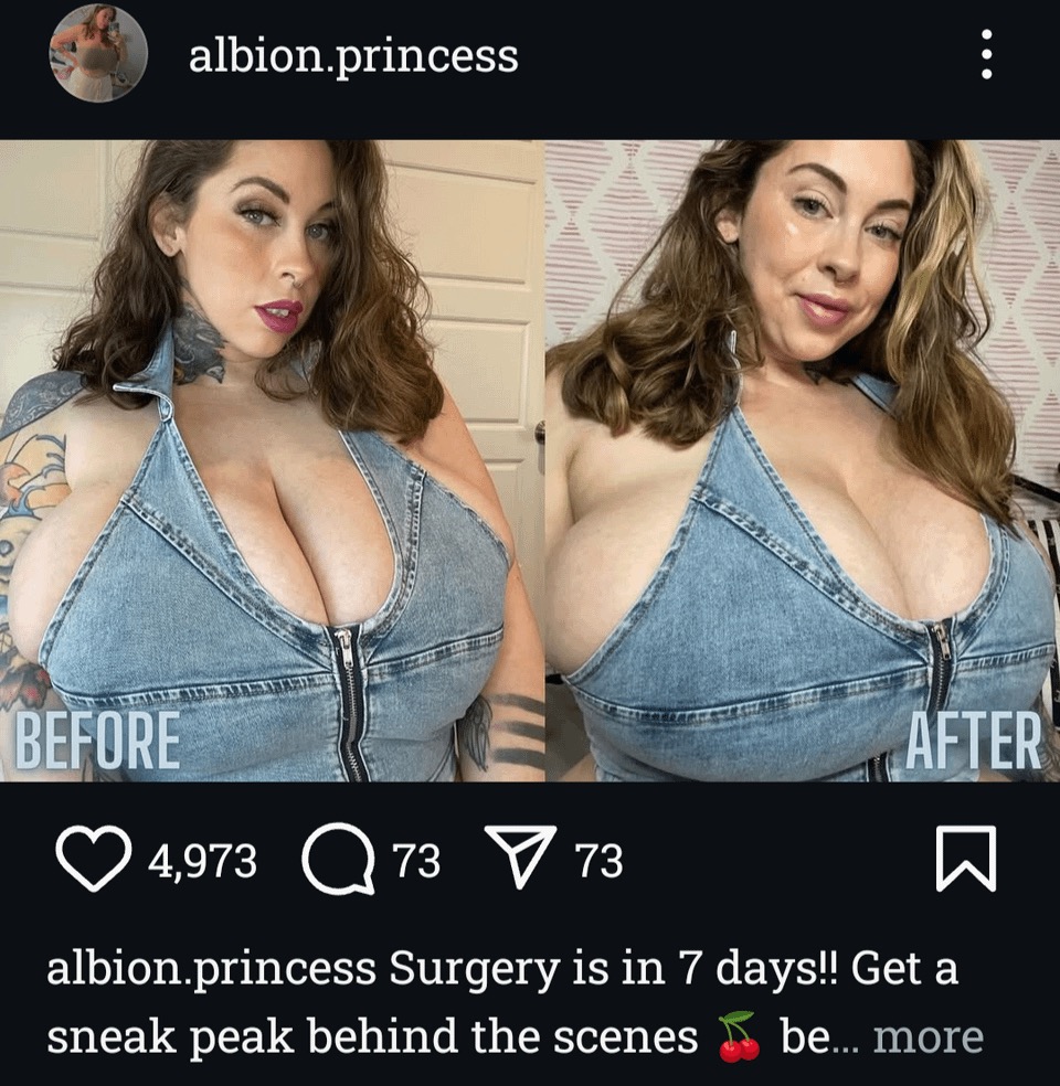 the image is a beforeandafter photo comparison from a social media post by an influencer named albion.princess.  it shows a woman wearing a denim halter top, highlighting a significant increase in breast size following a surgical procedure. the "before" picture displays her before surgery, and the "after" shows the results of what appears to be a breast augmentation. the post announces that the surgery is seven days away and promises a behindthescenes look at the process.  the image includes likes, comments, and shares counts typical of social media posts.
