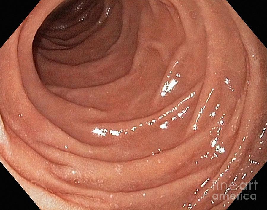 a closeup view of the inside of a human small intestine as seen through an endoscope. the image shows the folds and wrinkles of the intestinal lining, which are responsible for increasing the surface area for absorption of nutrients. the image is used for medical purposes to diagnose and treat various conditions affecting the digestive system.