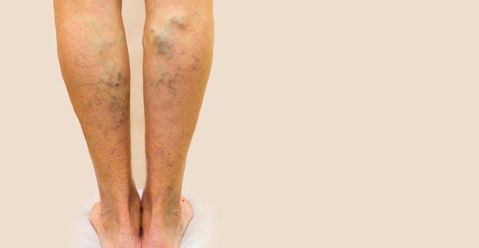 The back of a pair of legs with badly bulging various veins