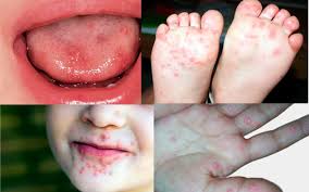 Surto de Mão-Pé-Boca já atinge 4 estados do Brasil - Jornal Contábil