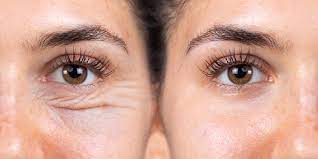 Cirurgia de Blefaroplastia - Indicações, Tipos, Como é Realizada -  Oftalmologia