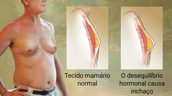 Homem sem camisa com tecido mamÃ¡rio inchado. Close comparando tecido mamÃ¡rio normal com tecido mamÃ¡rio inchado causado por desequilÃ­brio hormonal.