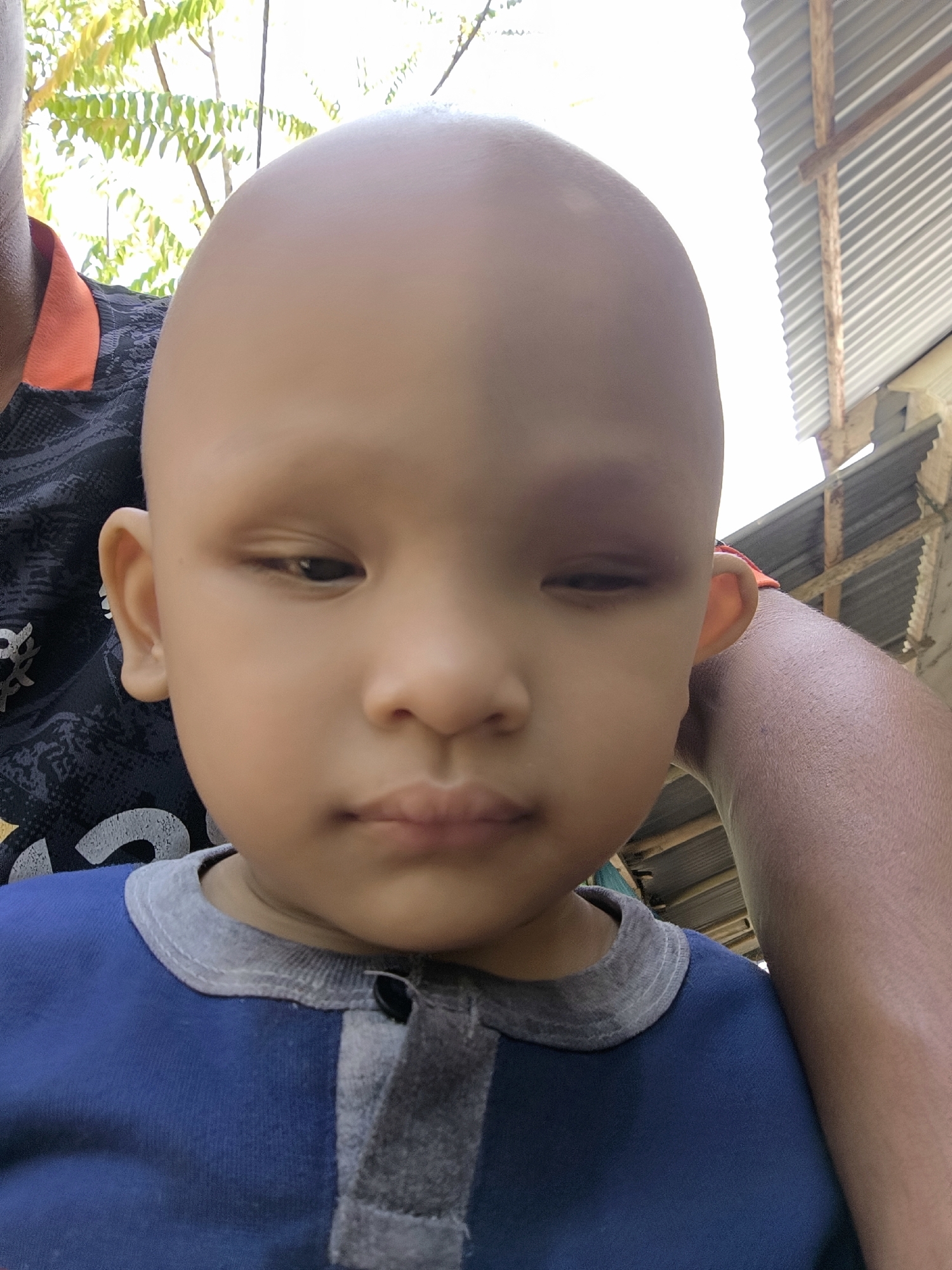 Child with visible eye injury photographed in Blangseureukuy, Indonesia