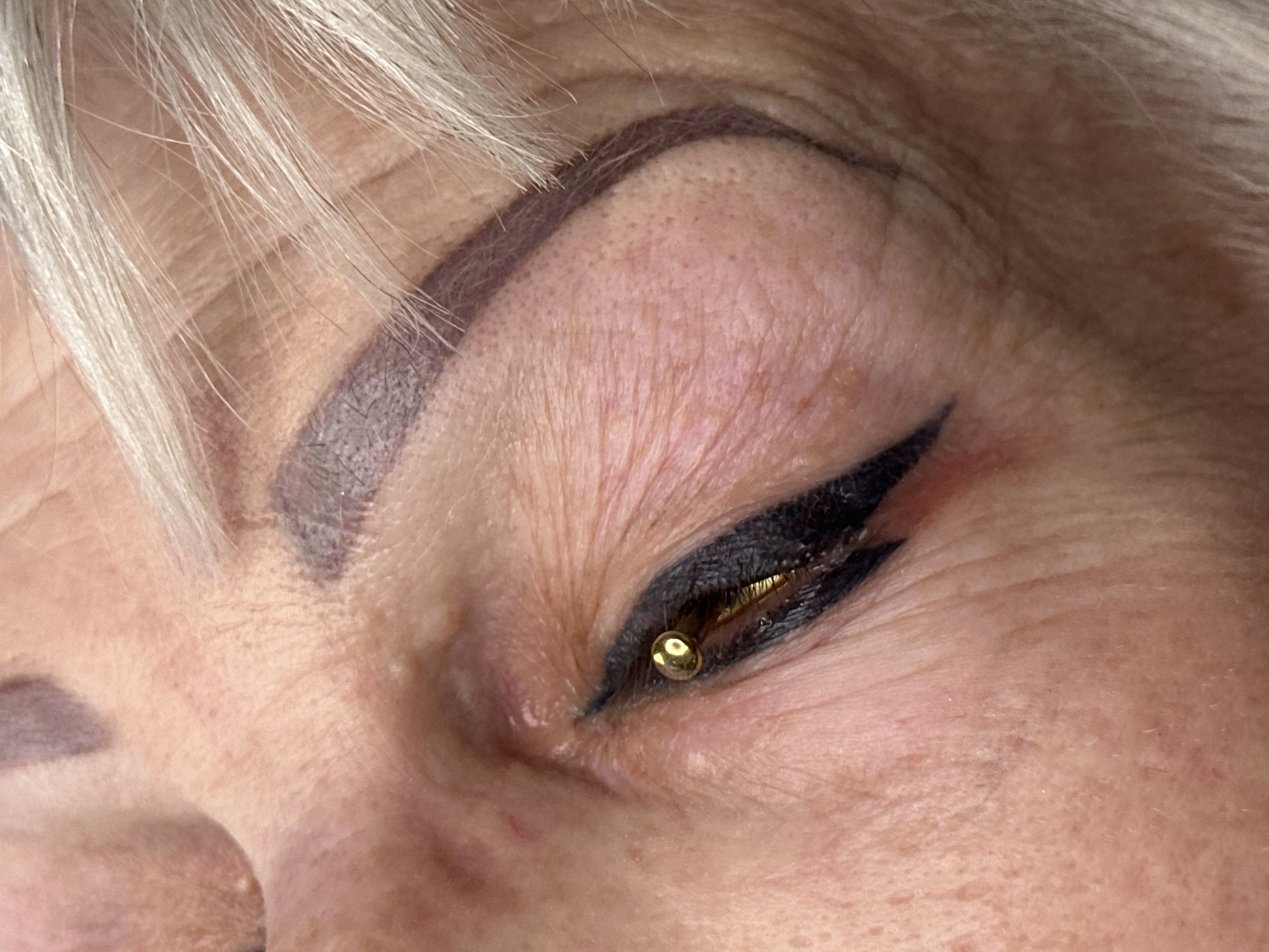 Cosmetic laser procedure performed in Riga, Latvia