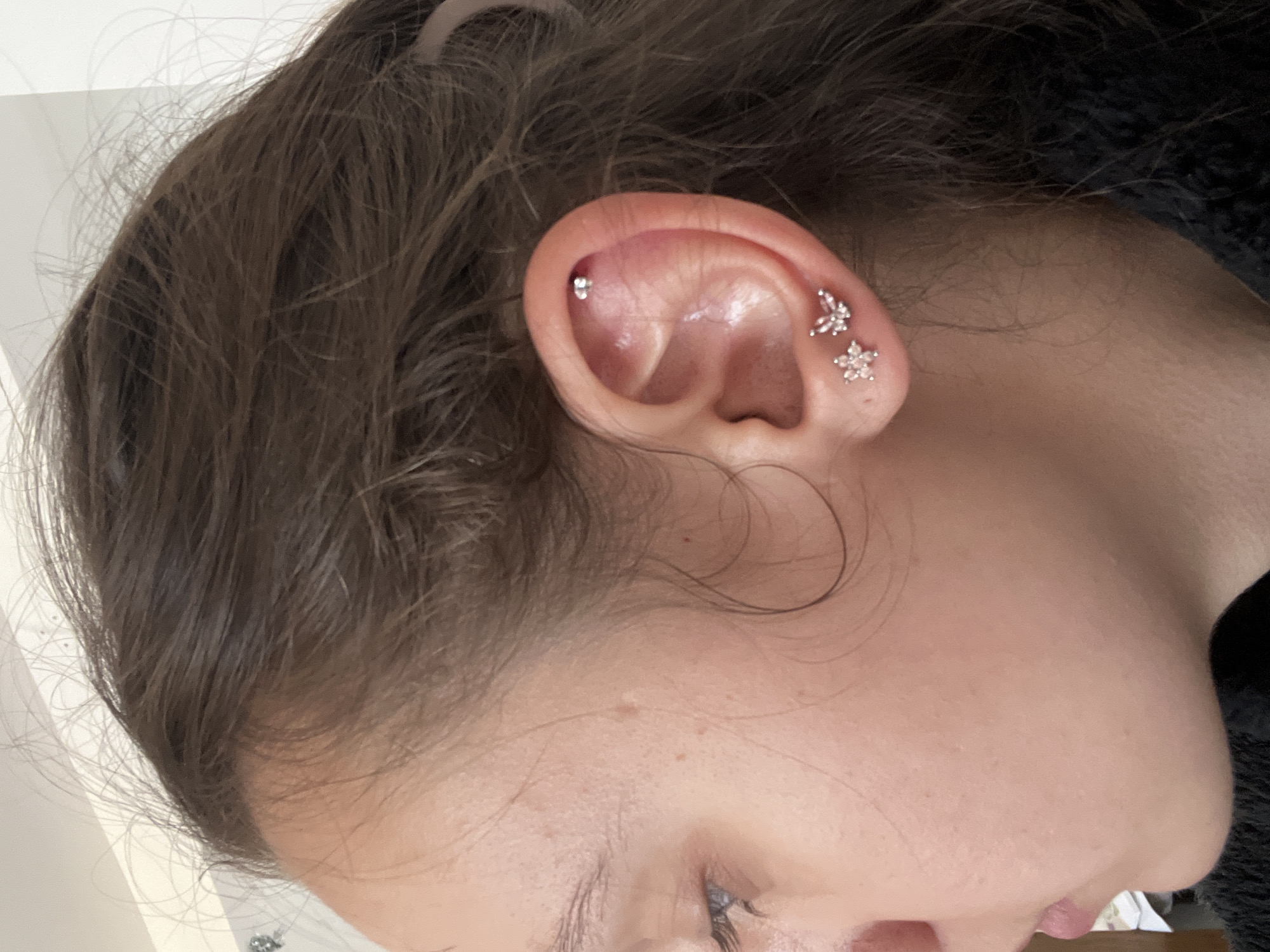 Ear acupuncture session documented in Saarbrücken