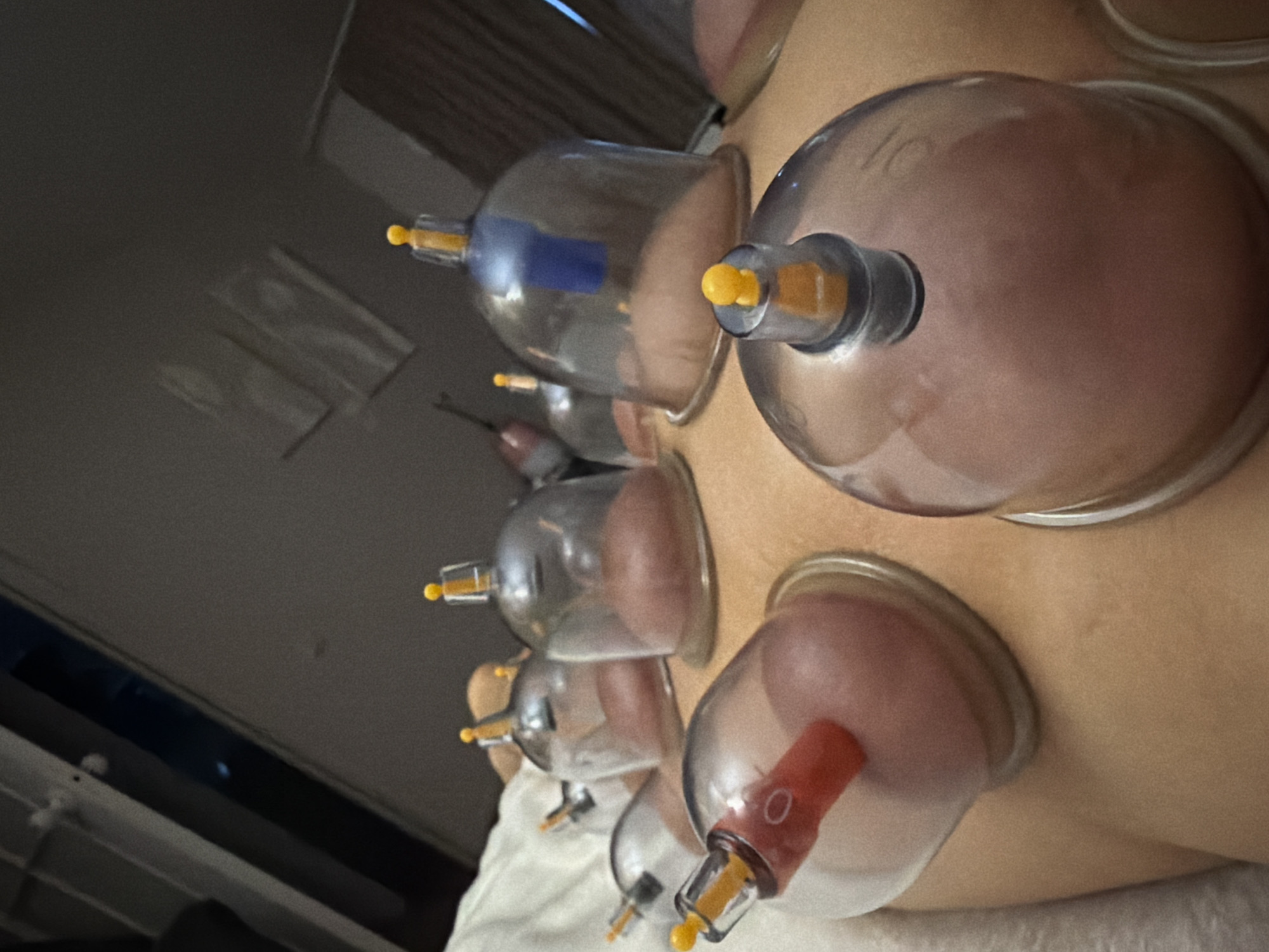 Cupping therapy session documented in Saint Petersburg