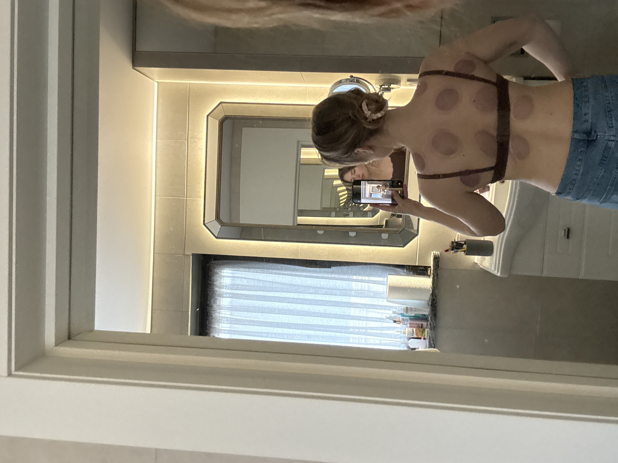 Person documents cupping therapy marks in bathroom selfie