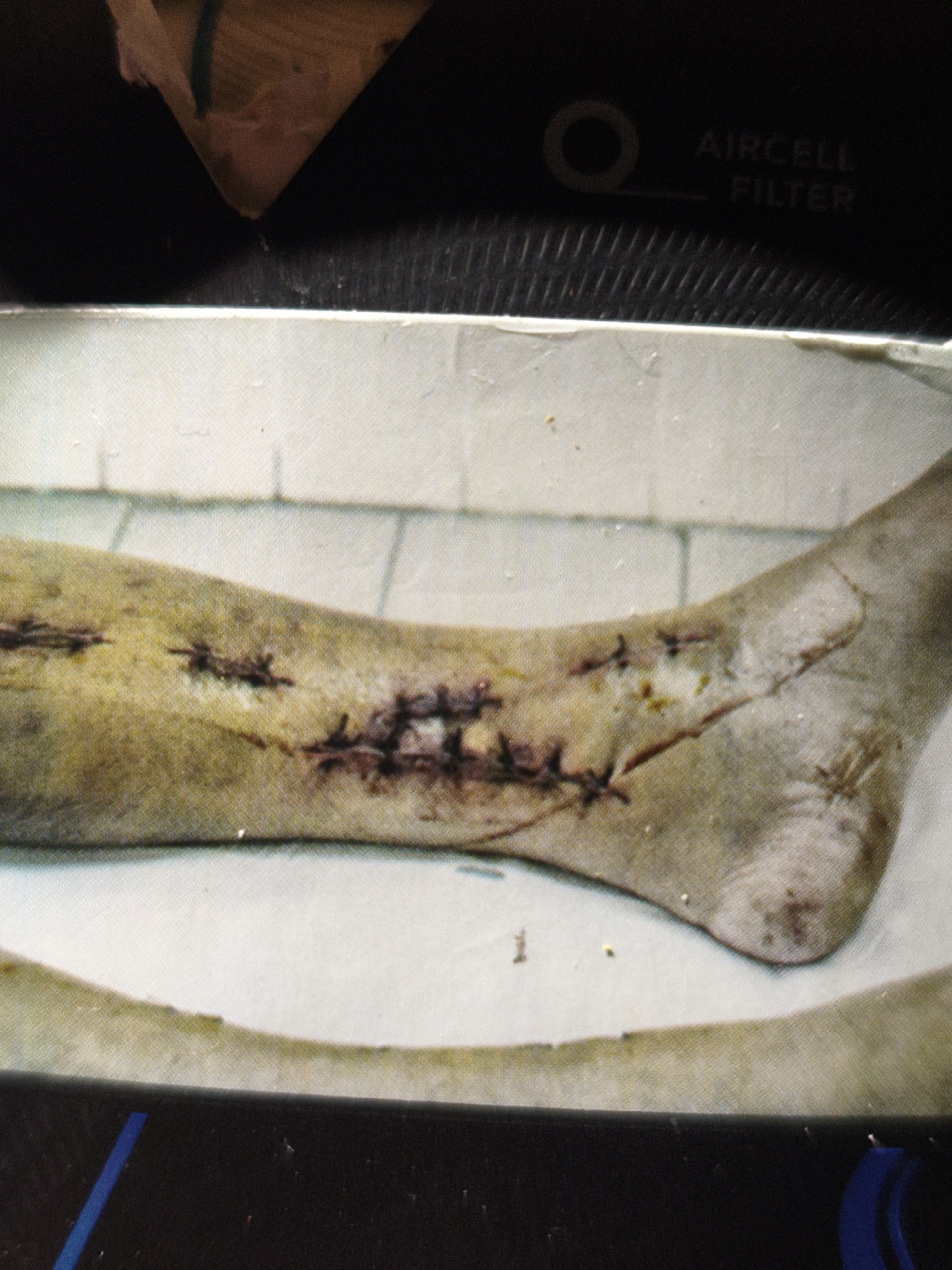 Post-surgical sutures on a discolored lower leg, Lithuania
