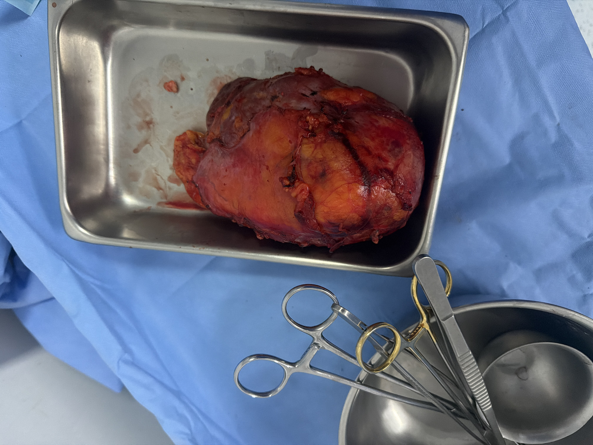 Surgical procedure with tissue mass documented in Puebla