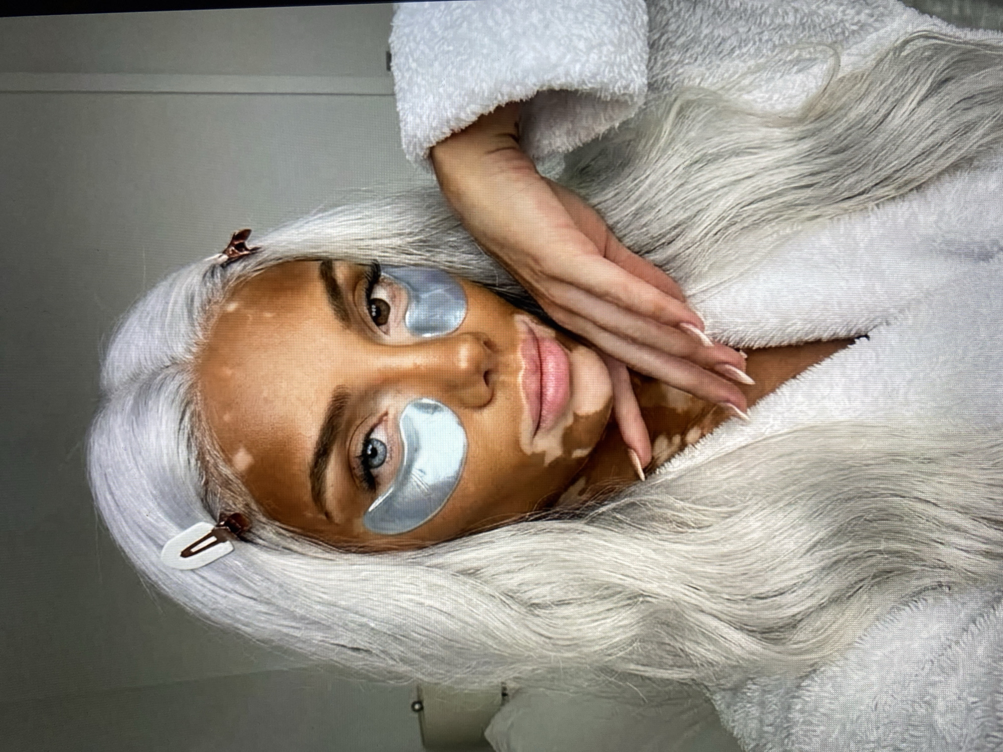 Woman with vitiligo documented during personal routine in Solikamsk