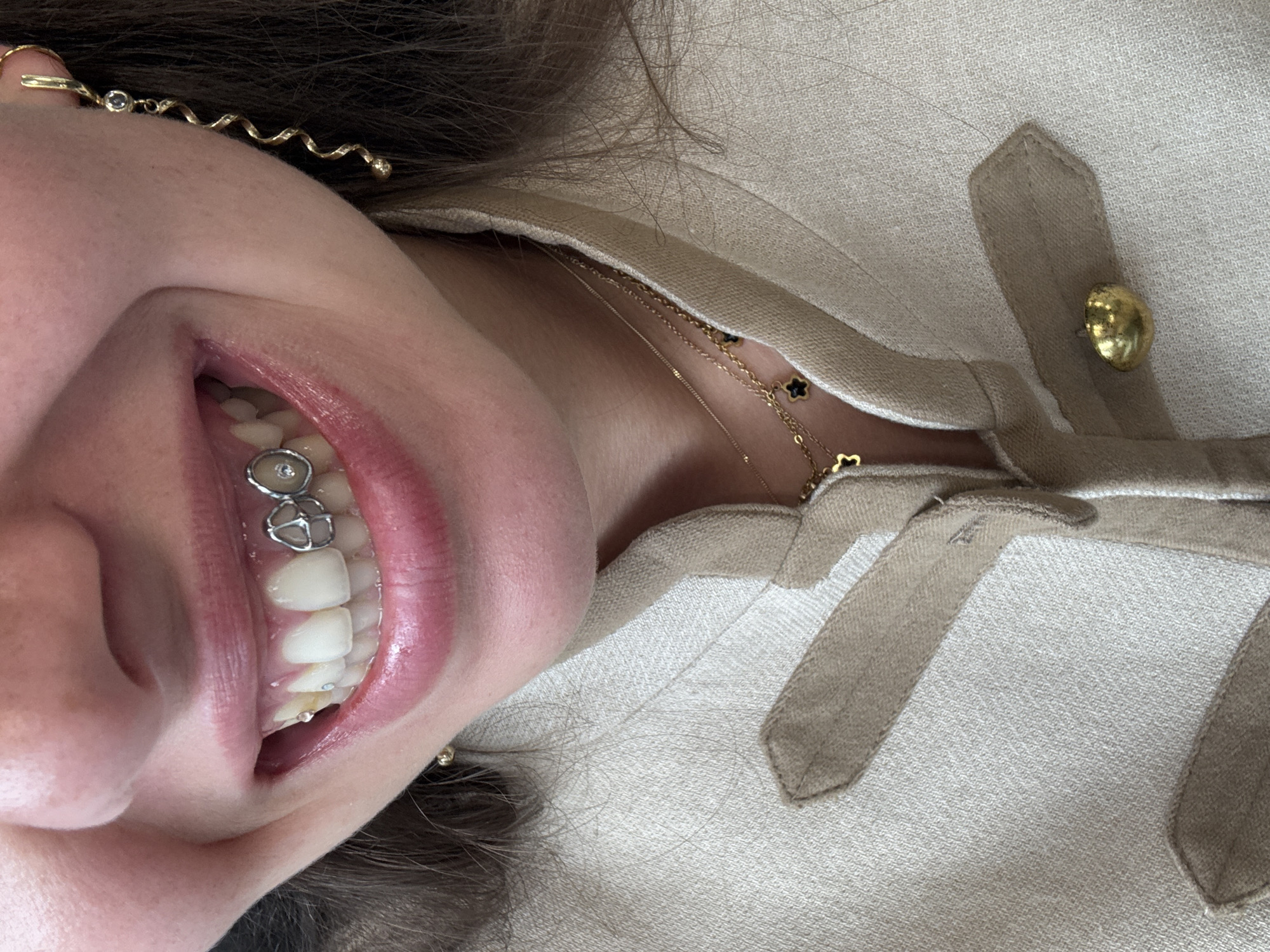 Person with braces photographed in casual video shoot, Lomazzo