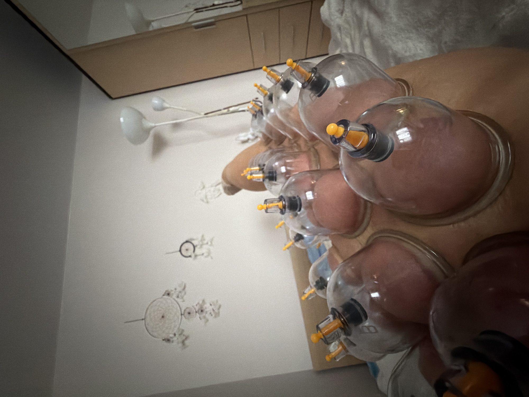 Cupping therapy session documented in Saint Petersburg
