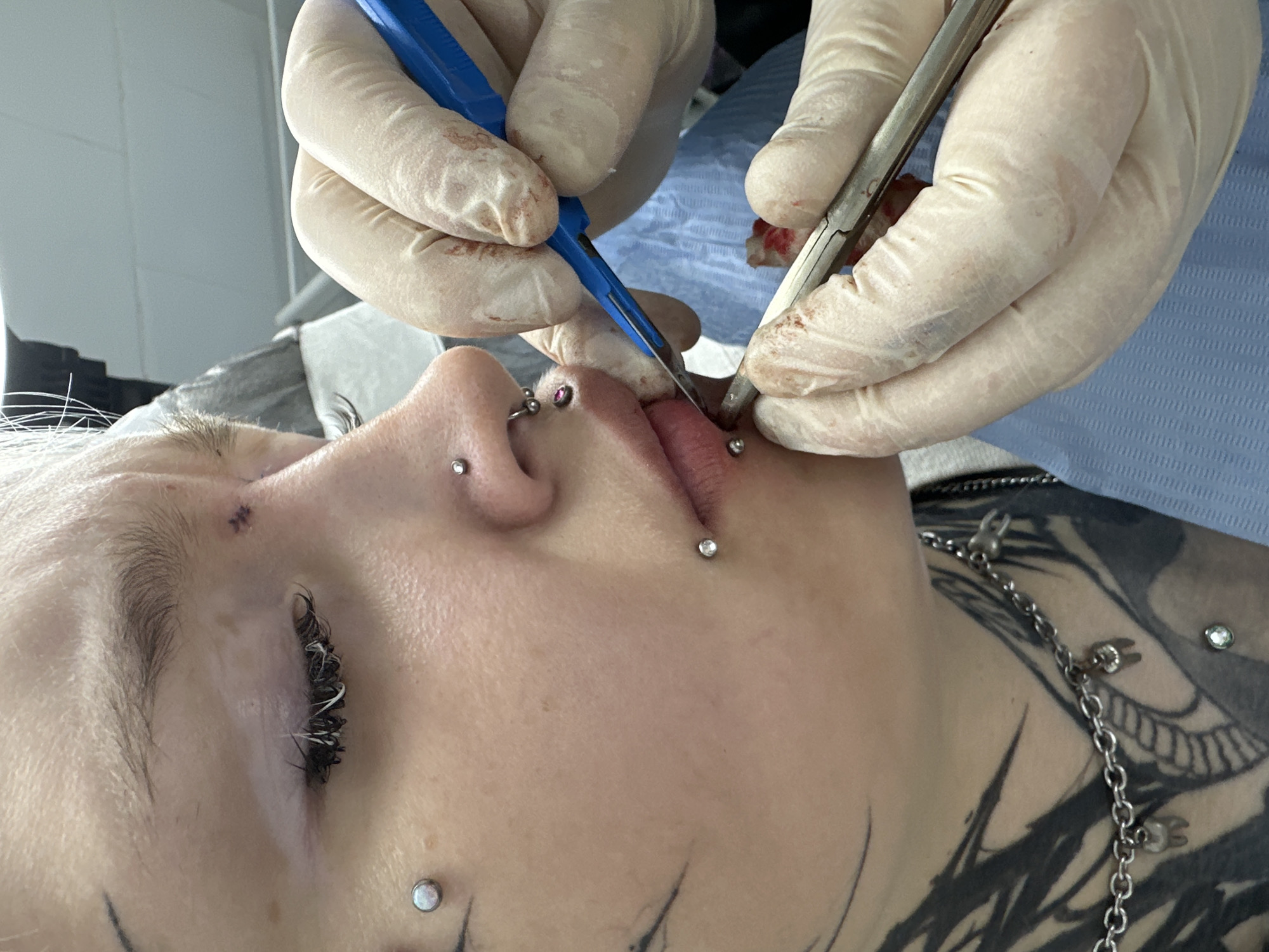 Tattooed individual receives body modification work in Saratov studio