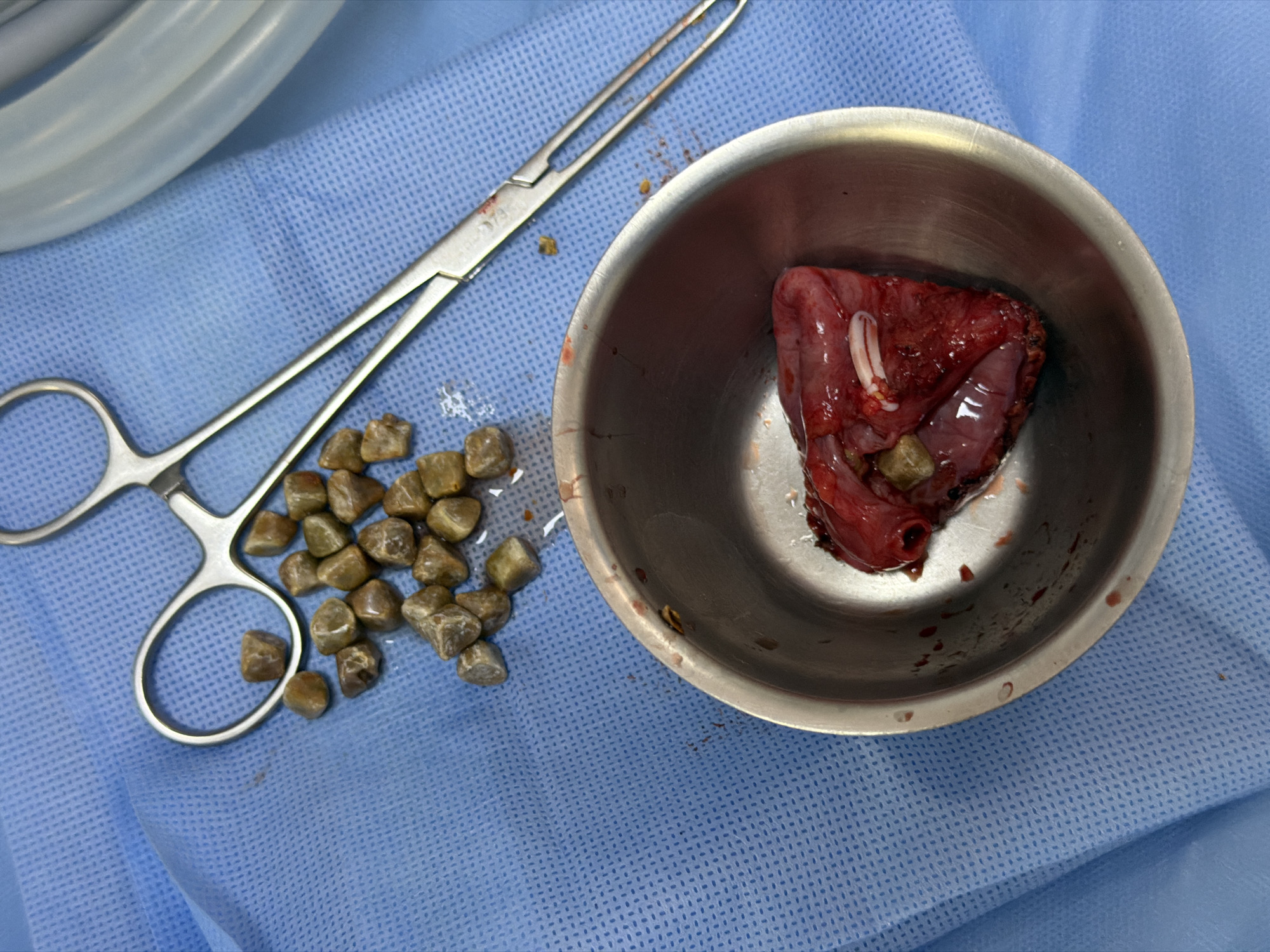Gallstone removal surgery documented in Puebla, Mexico