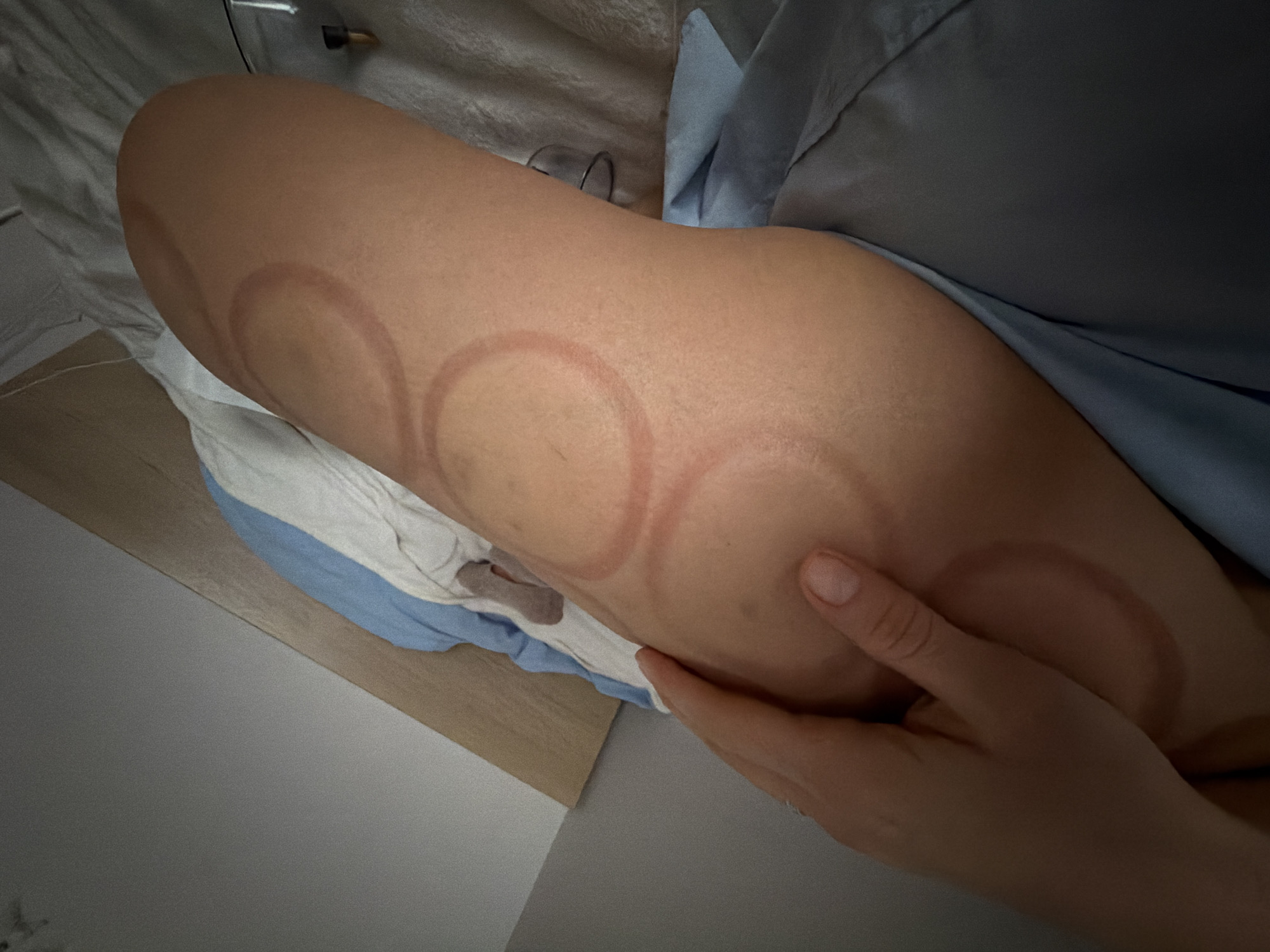 Cupping therapy session documented with multiple treatment marks