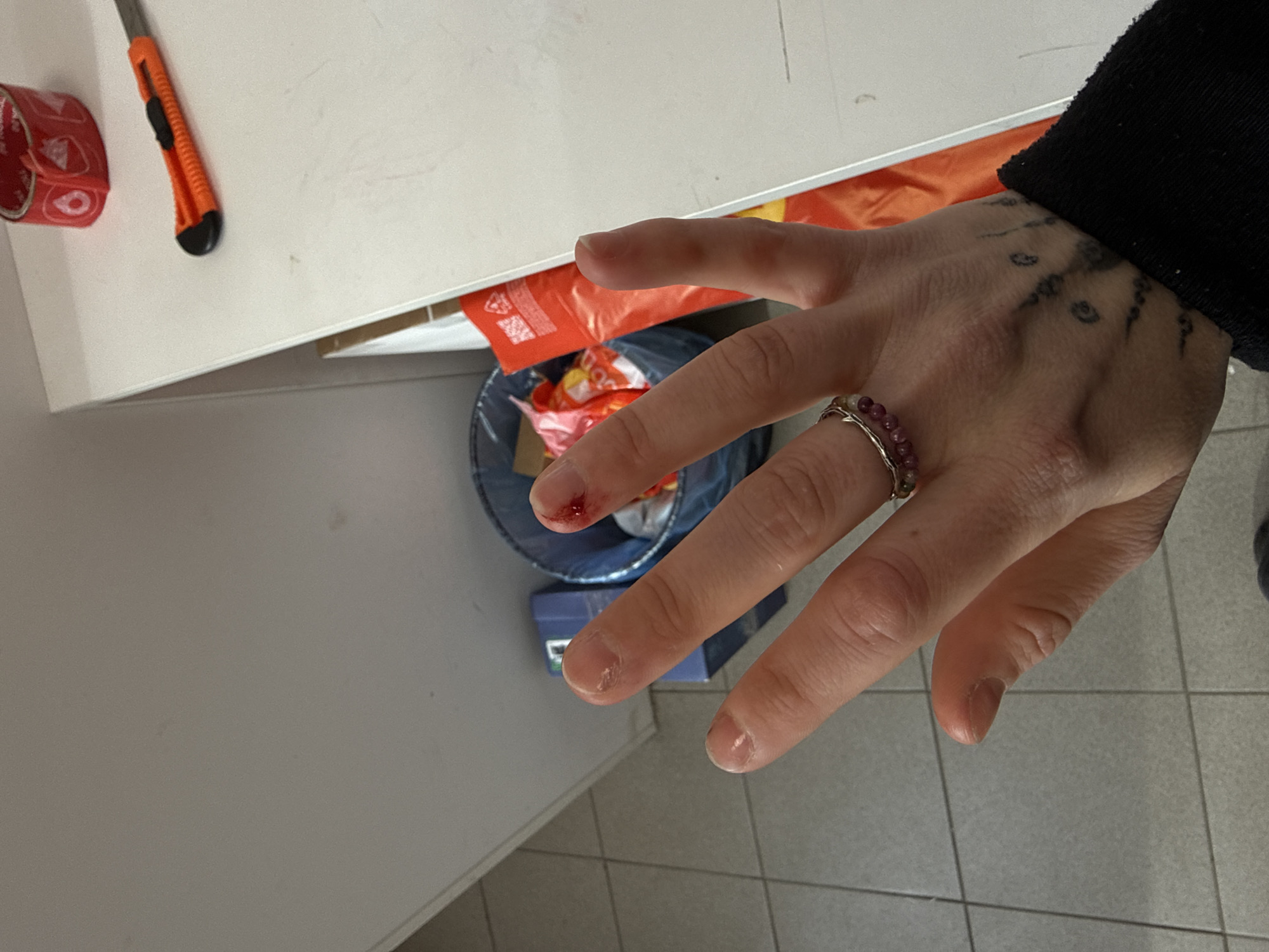 Minor finger injury documented in Saint Petersburg workspace