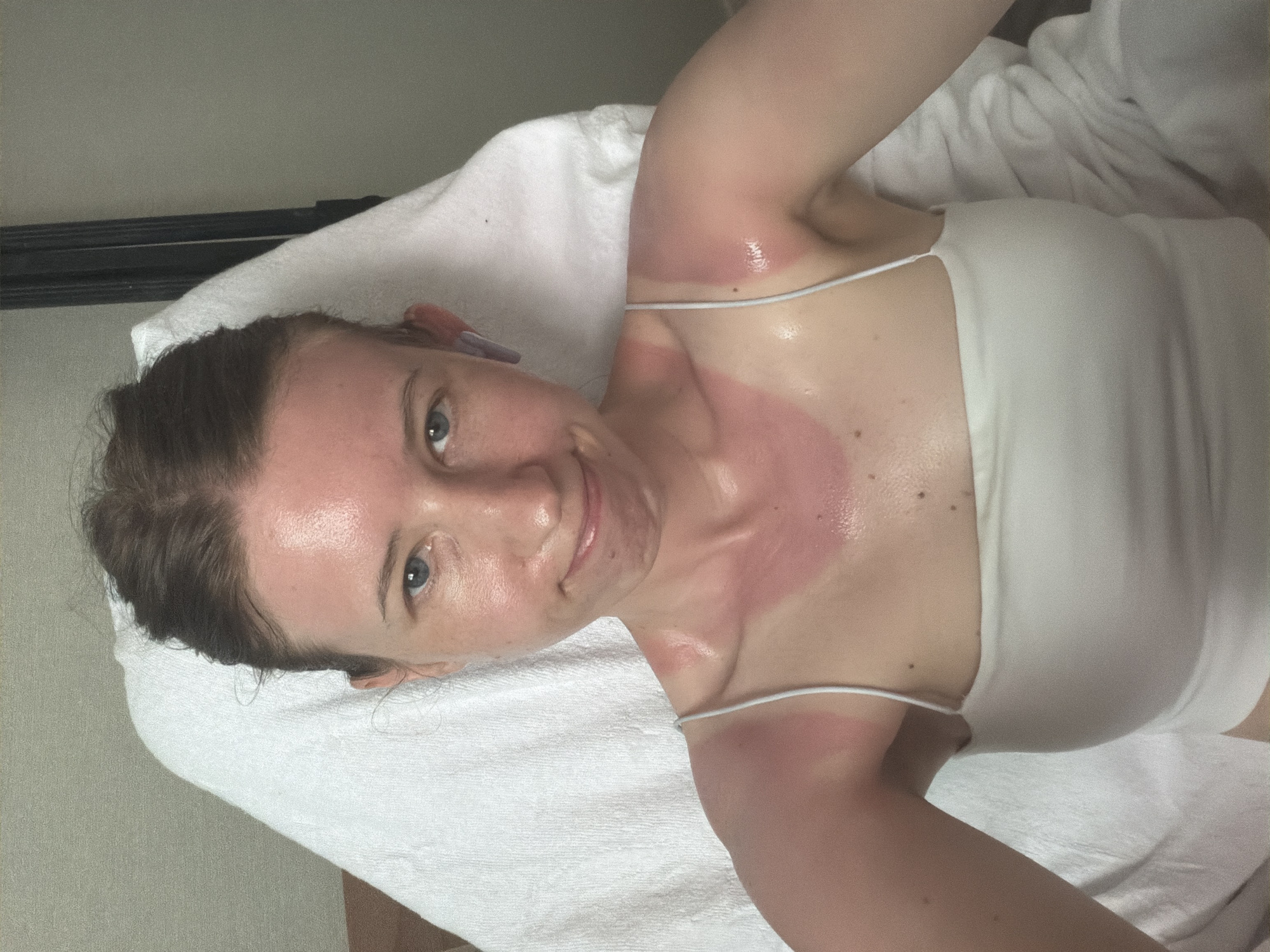 Dealing with a sunburn in a Dongducheon room