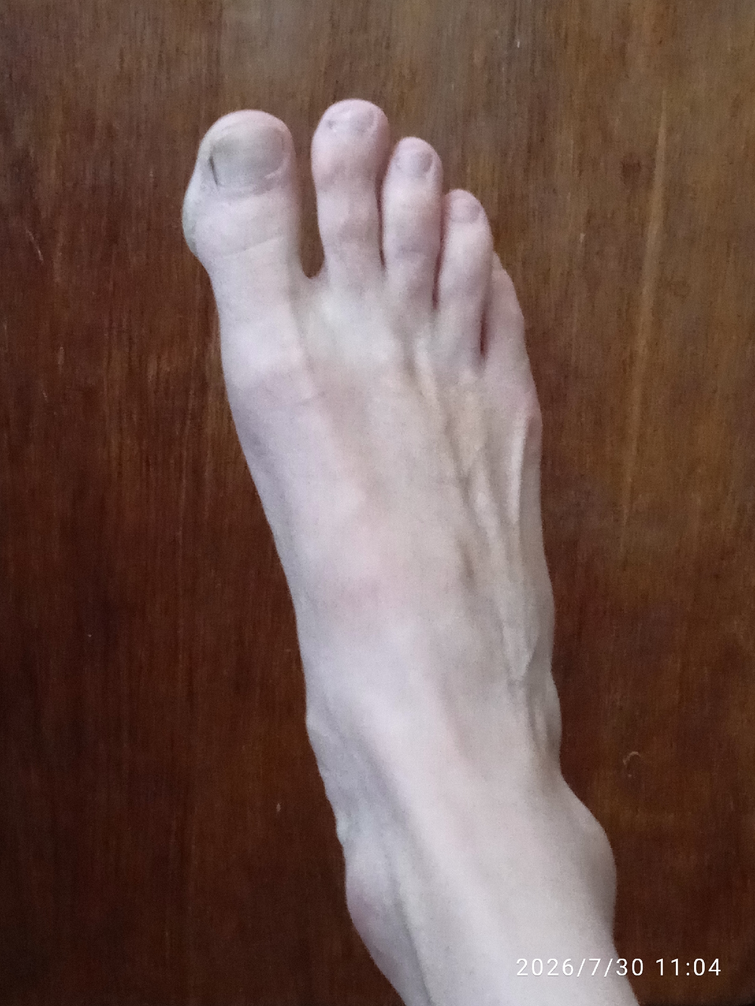 Close-up foot photos from multiple angles in a home setting.
