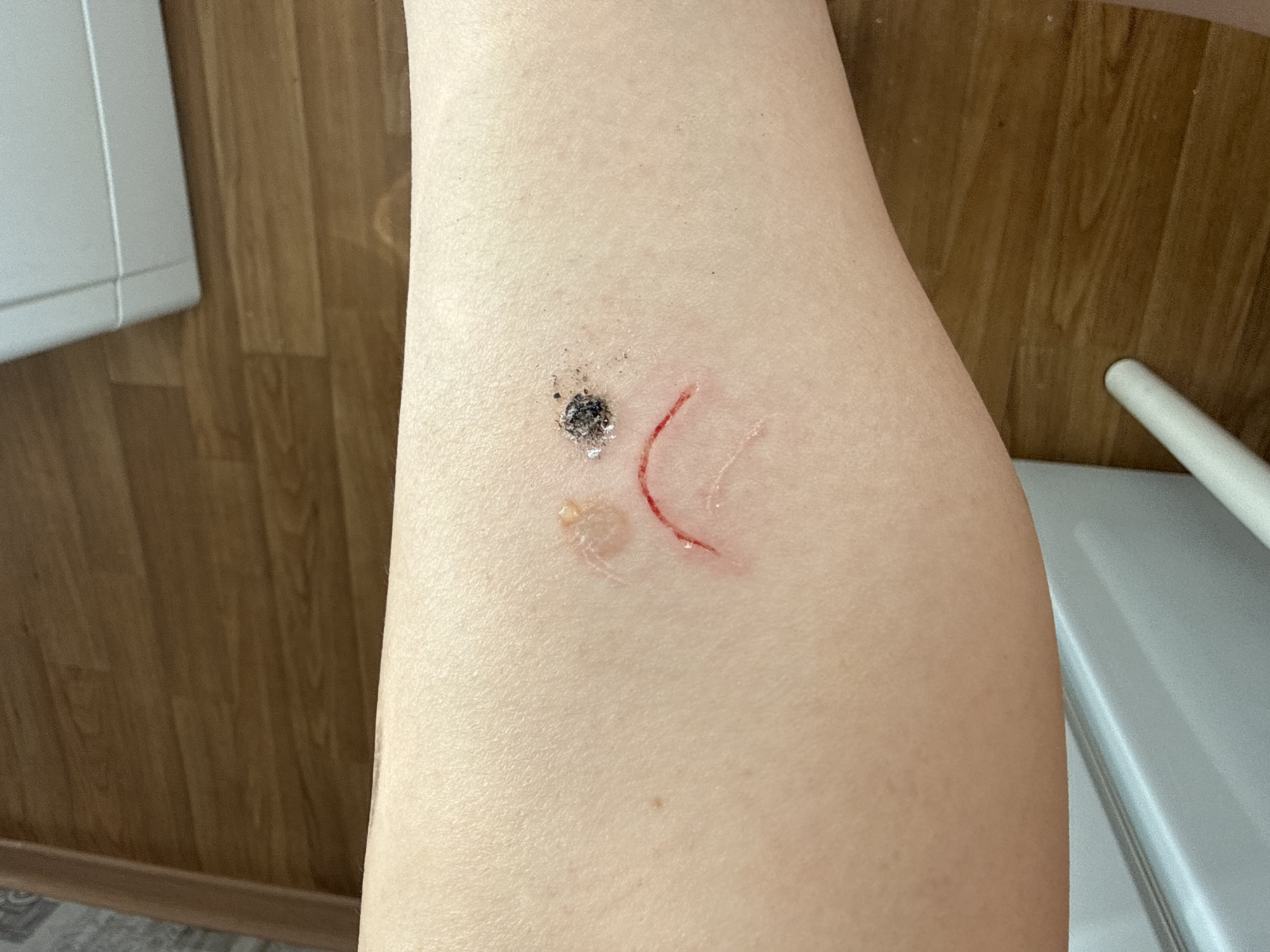 Saint Petersburg resident documents sad-face pattern skin injuries