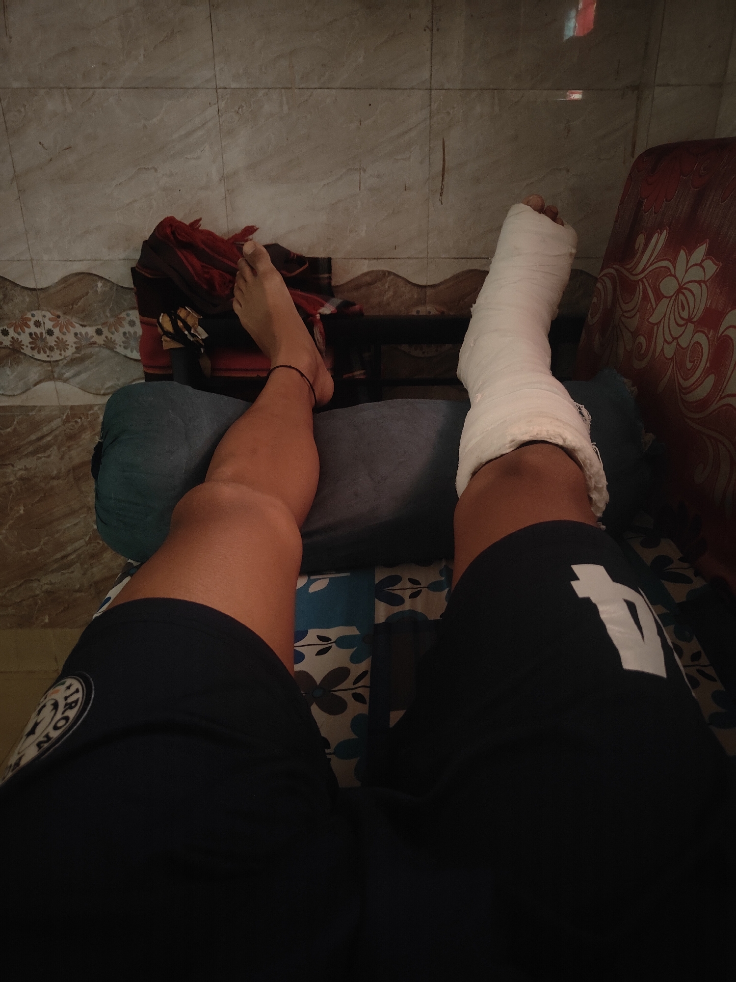 Person recuperates with elevated leg cast in Mumbai